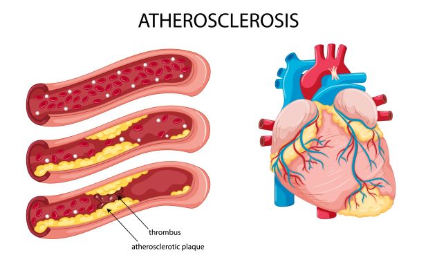 Ateroskleróza