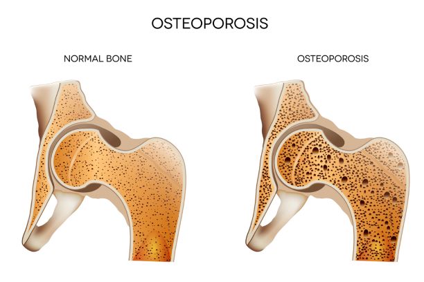 Kost zasažená osteoporózou