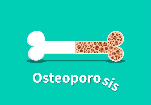 Osteoporóza - tichý lamač hlavně ženských kostí