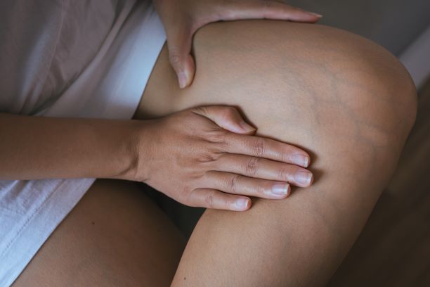 Vyvracíme mýty: Křečové žíly nesouvisí s během
