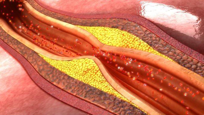 cholesterol