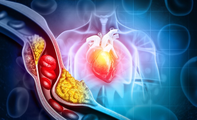 vysoký cholesterol