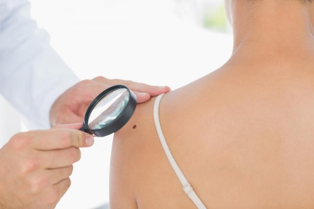 Preventivní vyšetření znamének předchází vzniku melanomu